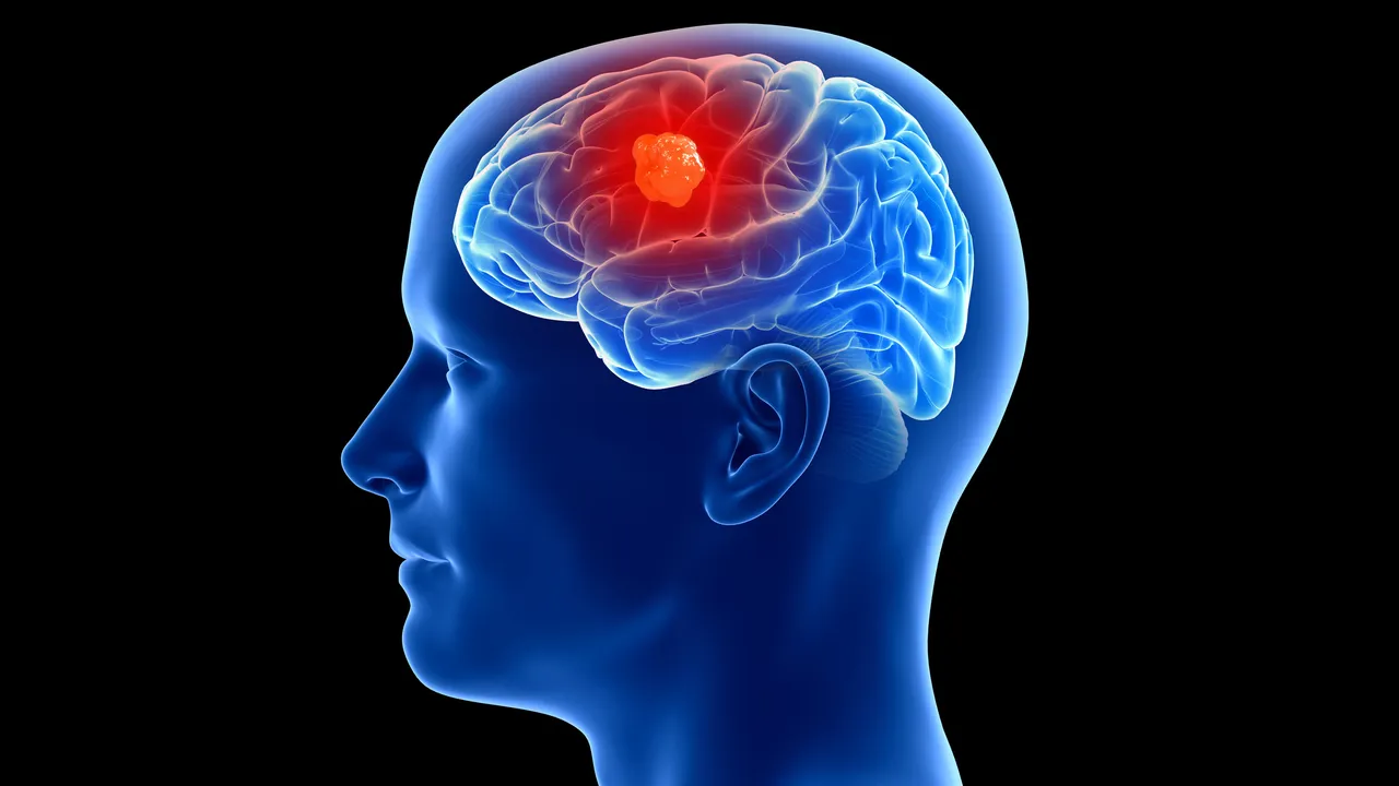 Este implante cerebral capaz de detectar cáncer será probado por primera vez