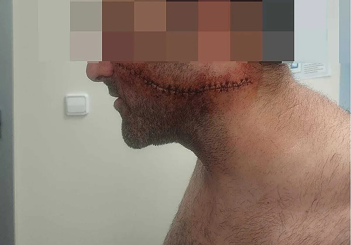Malaga healthcare worker needs 30 stitches after having face slashed by stranger