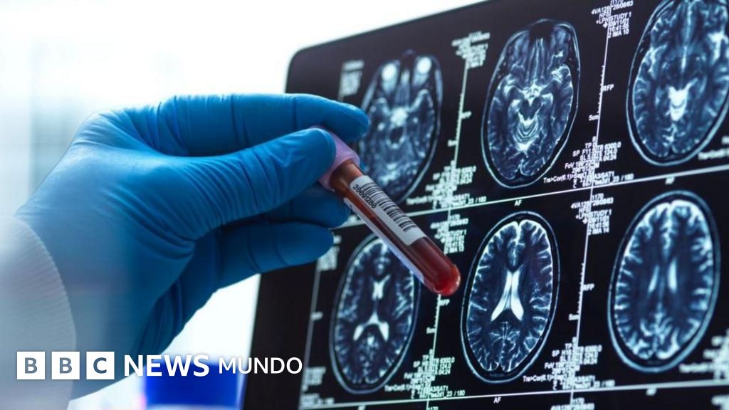 4 avances esperanzadores para la enfermedad de Alzheimer este año