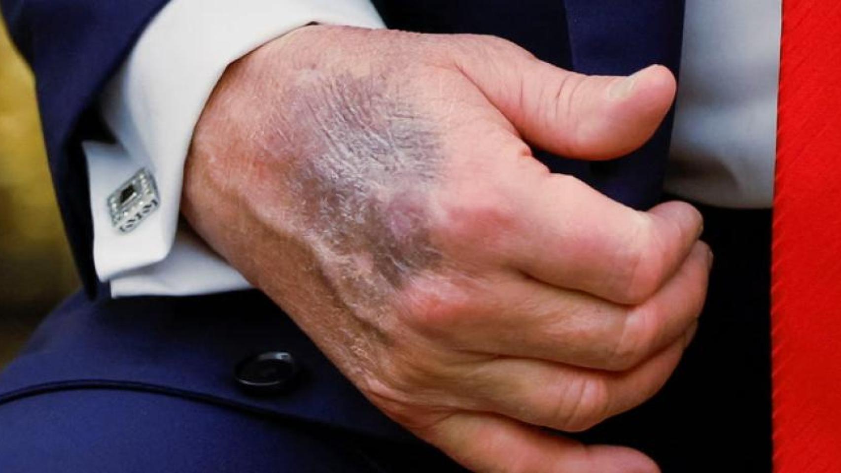 Moratones en las manos, problemas de sueño y un test cognitivo: las preocupantes señales sobre la salud de Trump