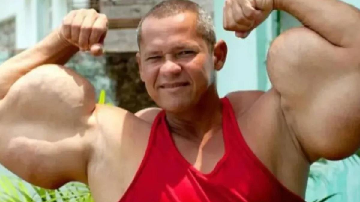 Muere el Popeye real que se inyectaba aceite para tener unos bíceps gigantes de 73 centímetros
