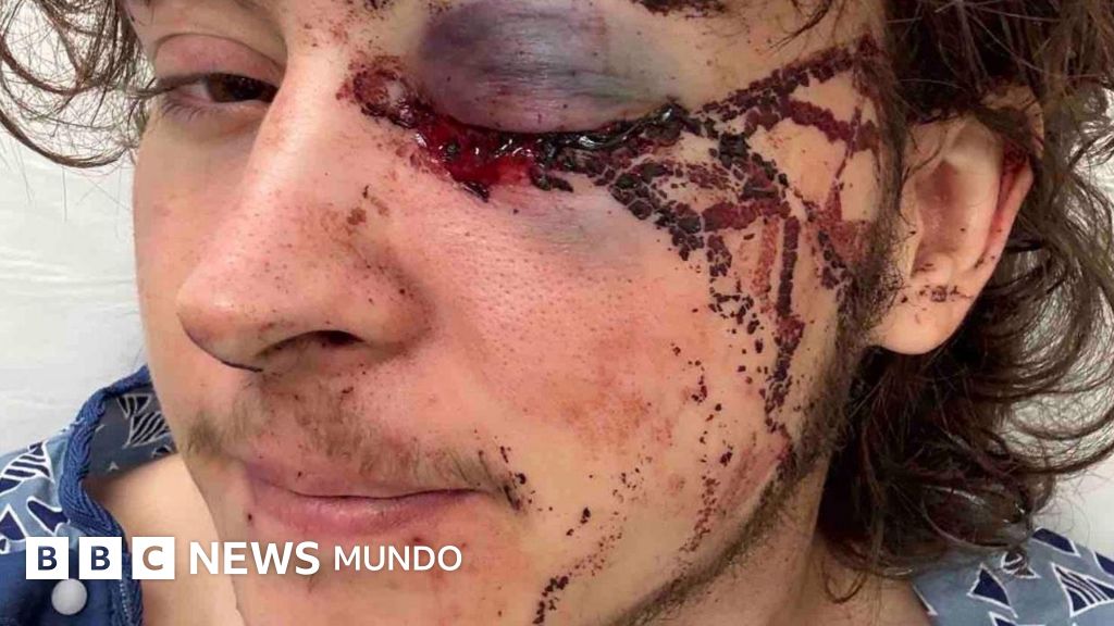 "Los médicos dicen que estoy vivo de milagro": el joven que perdió un ojo durante una protesta contra ICE en California