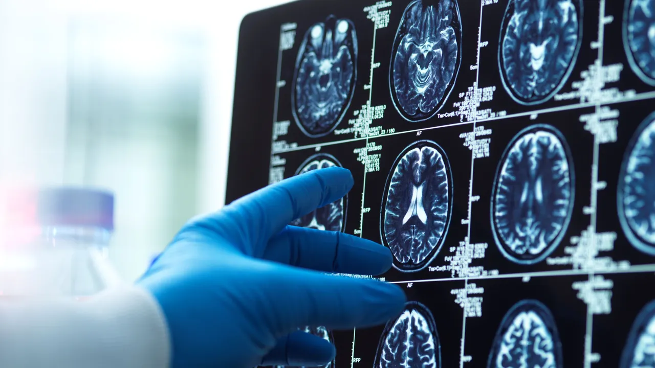 Por qué el cáncer puede reducir el riesgo de Alzheimer