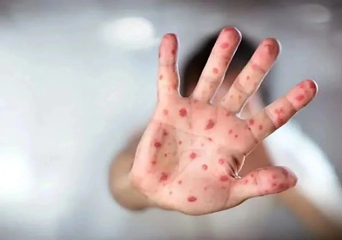 Los vacunados pueden infectarse de sarampión y uno solo podría contagiar a otros 20