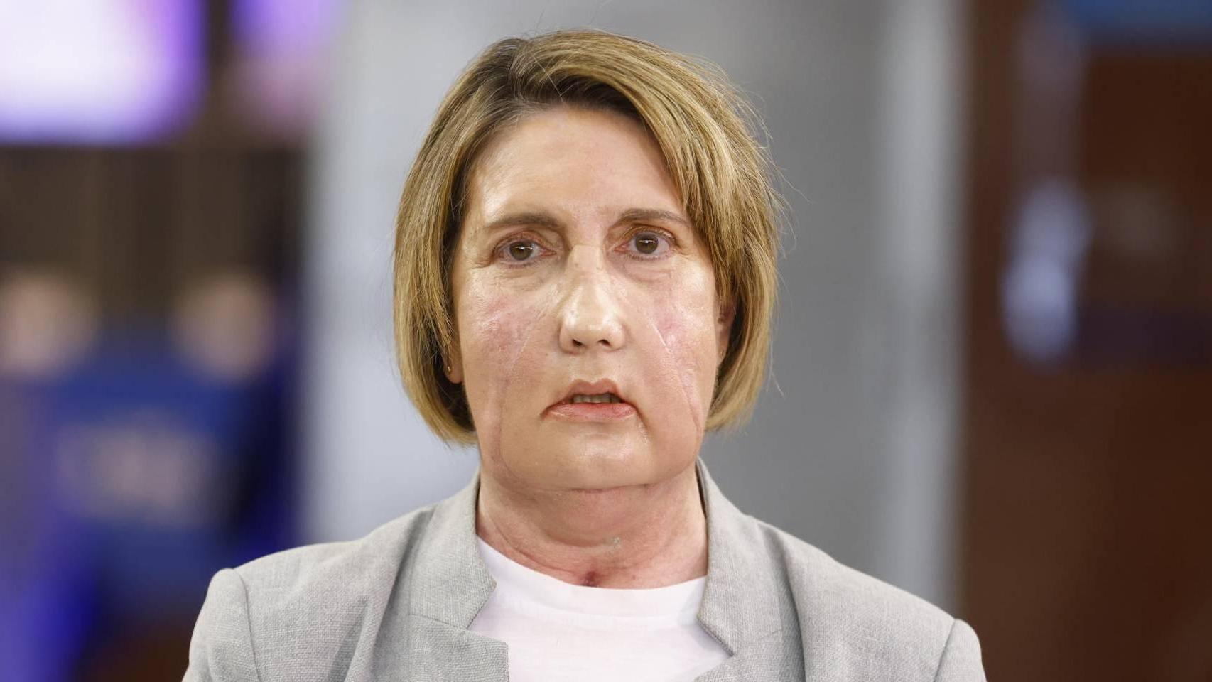 Hito en España: el Vall d’Hebron realiza el primer trasplante de cara con una donante que recibió la eutanasia