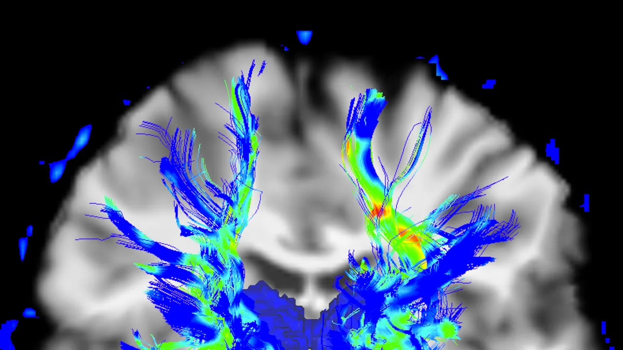 Científicos identifican una red cerebral que podría revolucionar el tratamiento del Parkinson