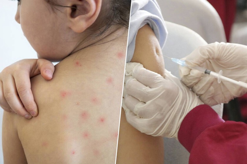 México, en la cuerda floja: el brote de sarampión roza los 8.500 casos y pone en jaque el estatus sanitario del país