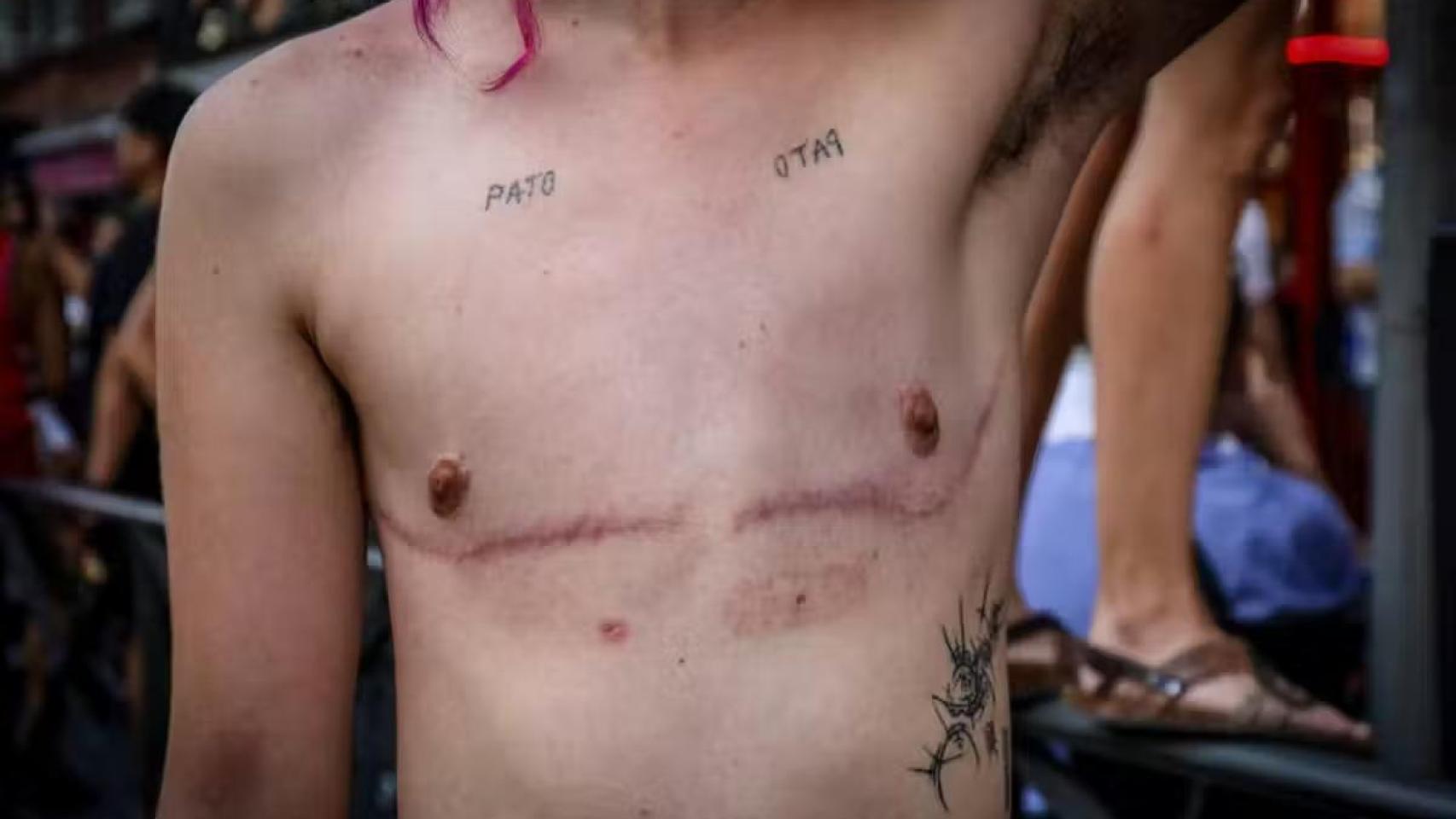 Las operaciones de cambio de sexo en menores, en entredicho: los cirujanos de EEUU piden evitarlas hasta los 19 años