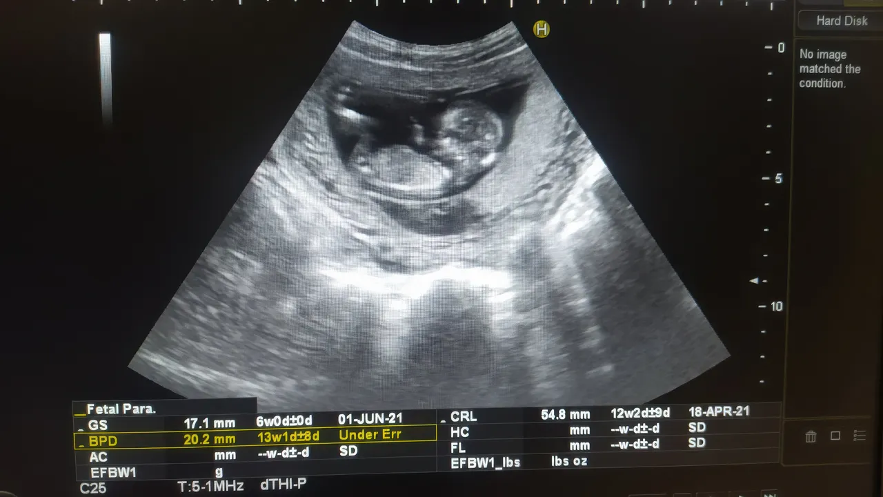 Los bebés antes de nacer están expuestos a “químicos eternos” y es peor de lo que pensábamos