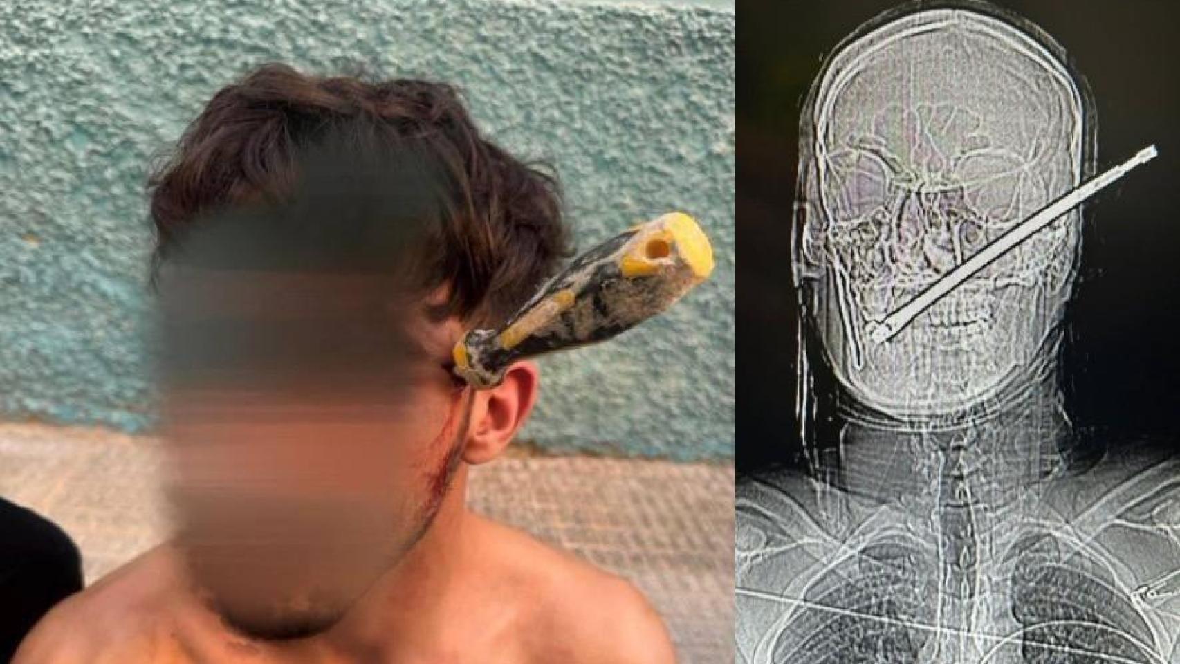 El milagro de Albatera: un joven sobrevive después de que otro le clave un destornillador en la cabeza "para ajustar cuentas"