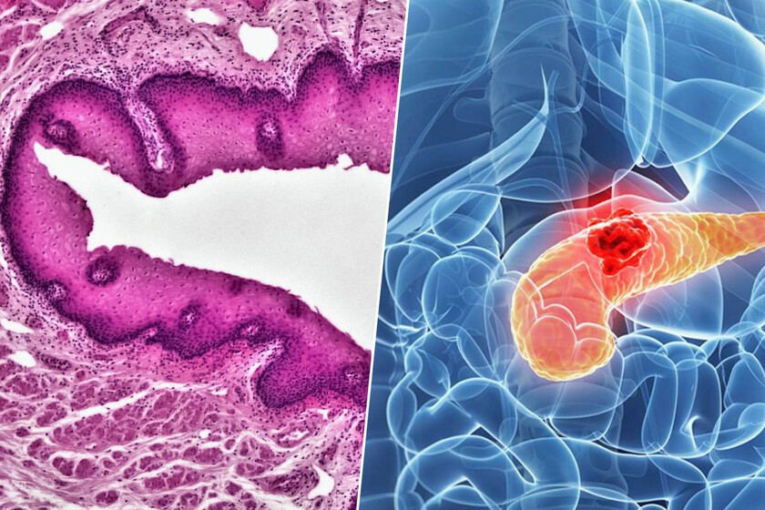 El cáncer de páncreas es un asesino silencioso. Una nueva terapia experimental ha logrado "interceptarlo" antes de que ataque