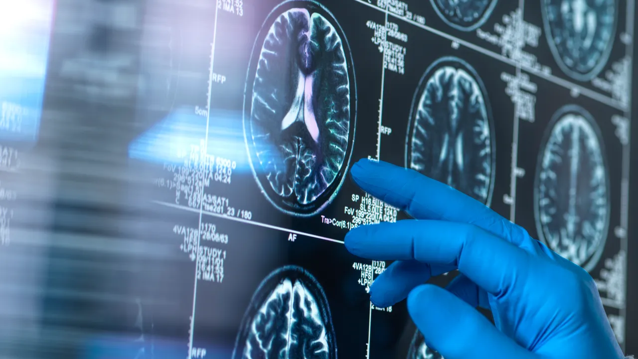 El Alzheimer presenta signos detectables incluso 10 años antes de manifestarse