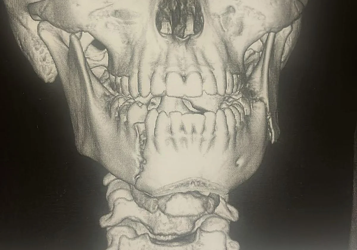 Un menor de 14 años, hospitalizado tras una grave agresión en un instituto de Fuengirola