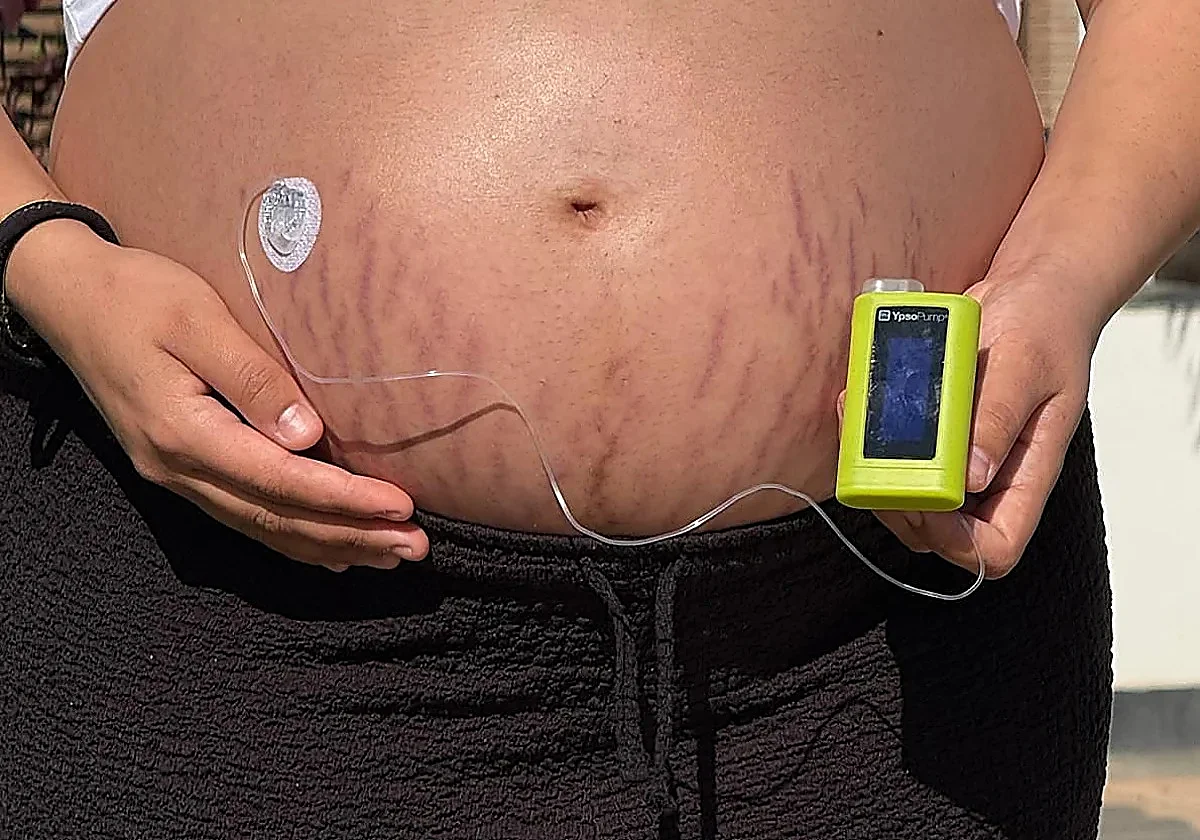 Malaga endocrinologist urges women to take measures against gestational diabetes