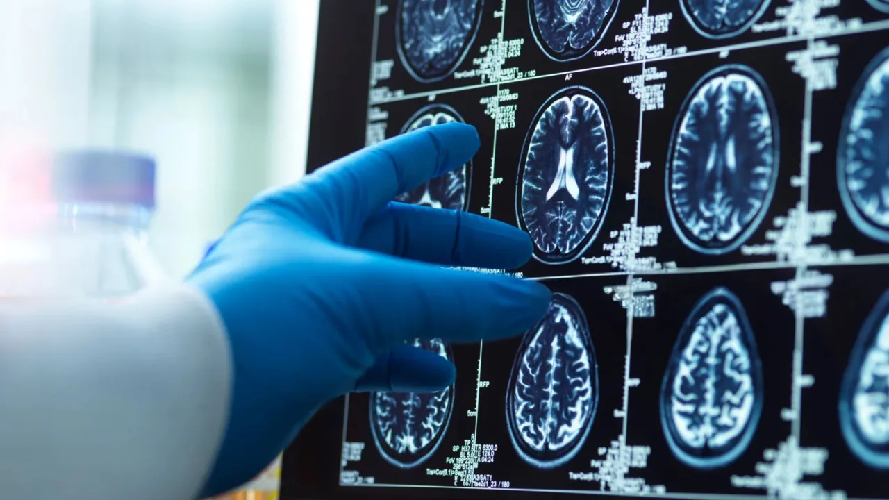 Este fármaco a base de cobre busca frenar el Alzheimer y mejorar la memoria